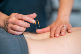 dry-needling